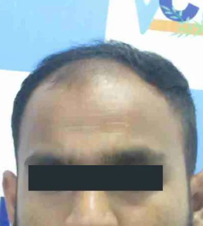 Activated Follicular Transplant Result Before in VCare
